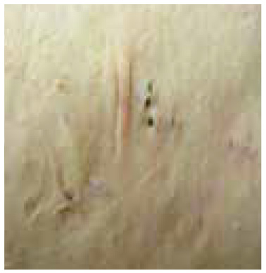 Hidradenitis suppurativa image