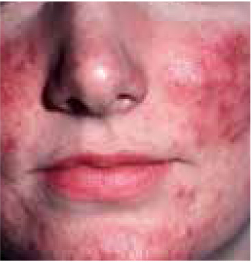 Rosacea