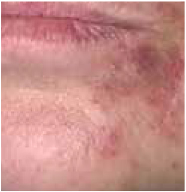 Perioral dermatitis