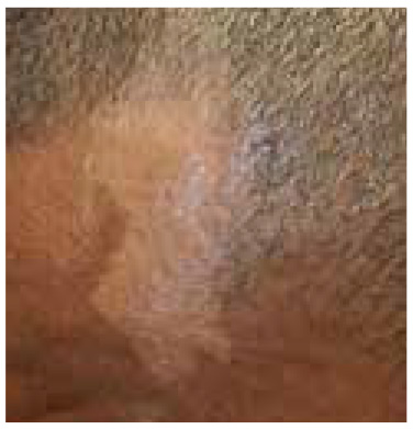 Nevus depigmentosus
