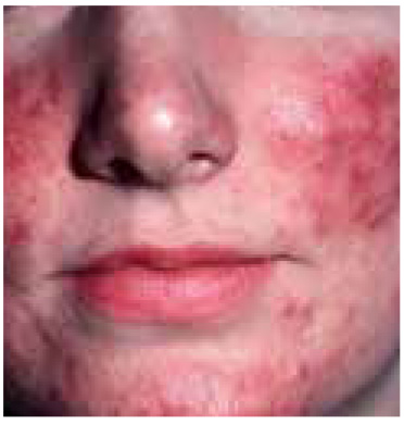 Pityriasis alba