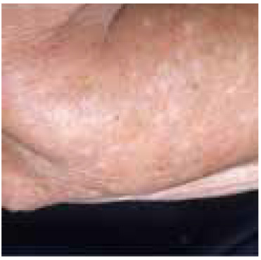 Idiopathic guttate hypomelanosis