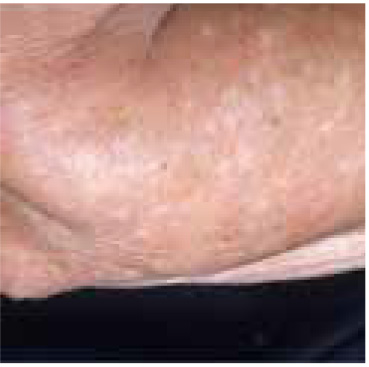 Tinea (pityriasis) versicolor 